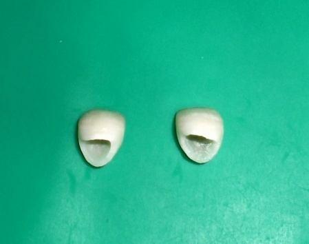 Simultaneously, one operator total-etched the cervical margins and the entire inner surface of the tooth crown with 37% phosphoric acid, followed by rinsing for 15 s.