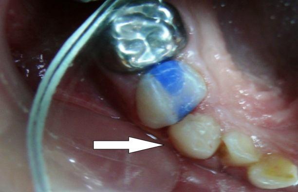 Malatya Abstract Primary teeth have fewer abnormalities with respect to size and morphology when compared to permanent teeth. Double-rooted primary canines are extremely rare dental anomaly.