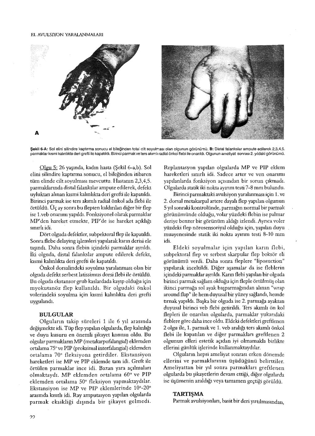 EL AVULSIYON YARALANMALARI A Şekil 6-A: Sol elini silindire kaptırma sonucu el bileğinden total cilt soyulması olan olgunun görünümü, B: Distal falankslar ampute edilerek 2,3,4,5.