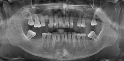 KRON KÖK KIRIĞI OLUŞMUŞ ÜST SANTRAL KESİCİ DİŞİN TEDAVİSİ 193 yenin iyi olmadığı ve çürüğe bağlı diş kaybı bulunan hastaya uygulanabilecek tedavi seçenekleri sunulmuştur (Şekil 1).