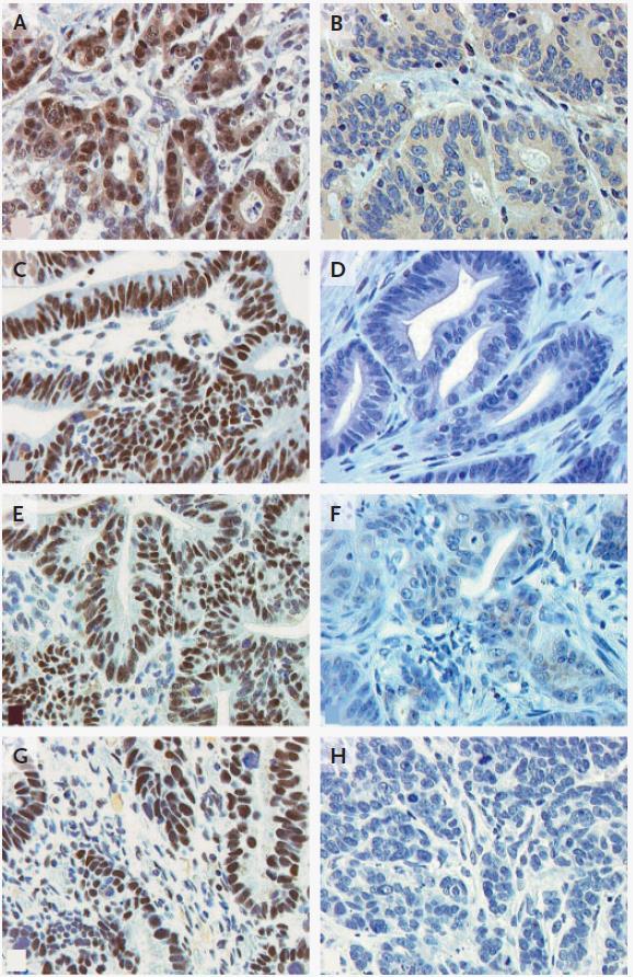 DNA Hatalı Eşleşme Tamir Genlerinin (MLH1, MSH2, MSH6 ve PMS2)