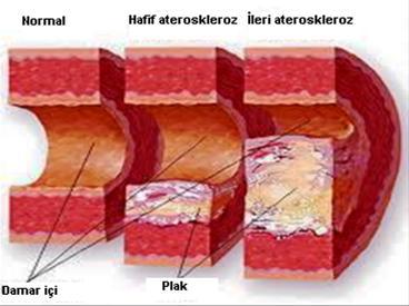 inflamasyona neden olmakta ve ateroskleroz gelişmektedir (Şekil-4). Lipid birikiminin devamı, plak içine kanama veya mural trombüs birikmelerinin artışı arterde tıkanmalara neden olmaktadır.