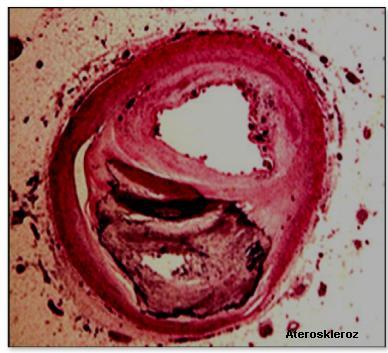 Şekil-5. Aterosklerozun mikroskobik görünümü 2.
