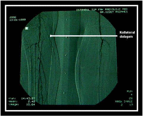 Şekil-6. Alt ekstremite kronik arter tıkanıklığında kollateral dolaşımın anjiyografi görüntüsü.