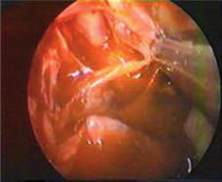 RESİM 3: Operasyon esnasında alınan endoskopik görüntü. Dura defekti ve BOS sızıntısının görünümü. (Renkli hali için Bkz. http://pediatri.turkiyeklinikleri.