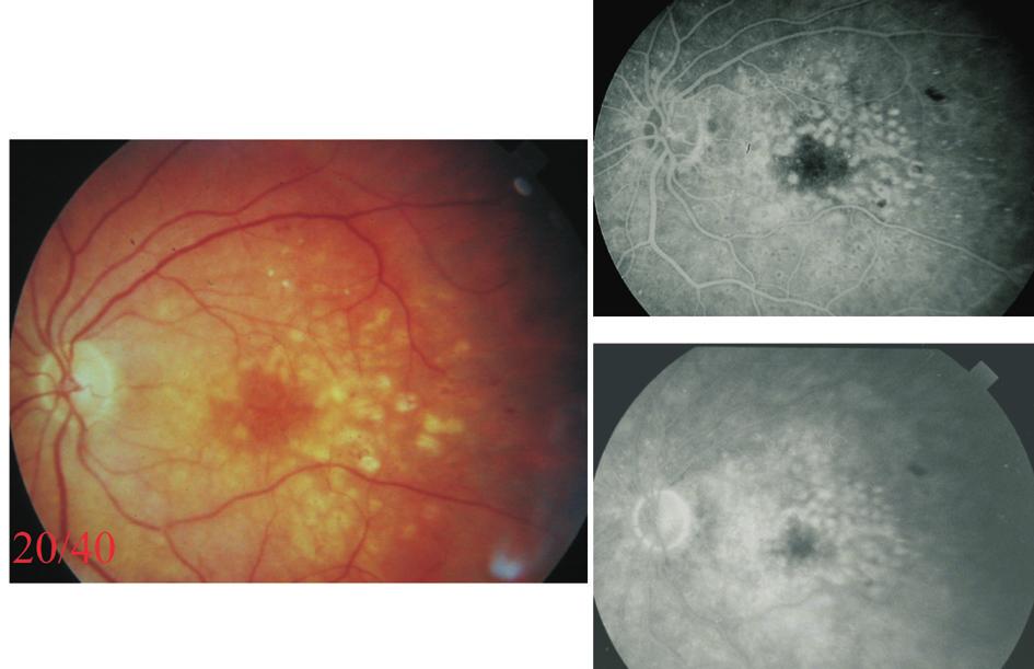 19 preoperatif deðerlendirmede kalýn ve gergin posterior hyaloid ve FFA'da diffüz sýzýntý izlenen 10 hastaya PPV uygulamýþlar, operasyon sýrasýnda 10 hastanýn üçünde gergin posterior hyaloide