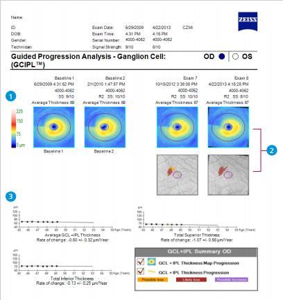 Guided Progression Analysis 1 Ganglion Cell (GC+IPL) GCL-IPL Kalınlık Haritası 2 Bazal Muayene Üst Alt Son 2