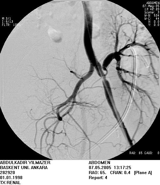 İliak Arterde RAS Anastomatik stenoz