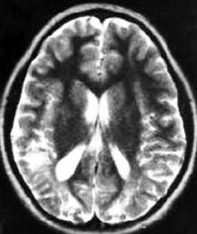 Ebru ARHAN et al LONG TERM NEUROLOGICAL OUTCOMES OF PATIENTS WITH NEONATAL HYPOGLYCEMIA TABLE 2: Magnetic resonance imaging findings and glucose levels Glucose levels ( mg/dl) 10-20 (n:8) 20-30 (n:6)