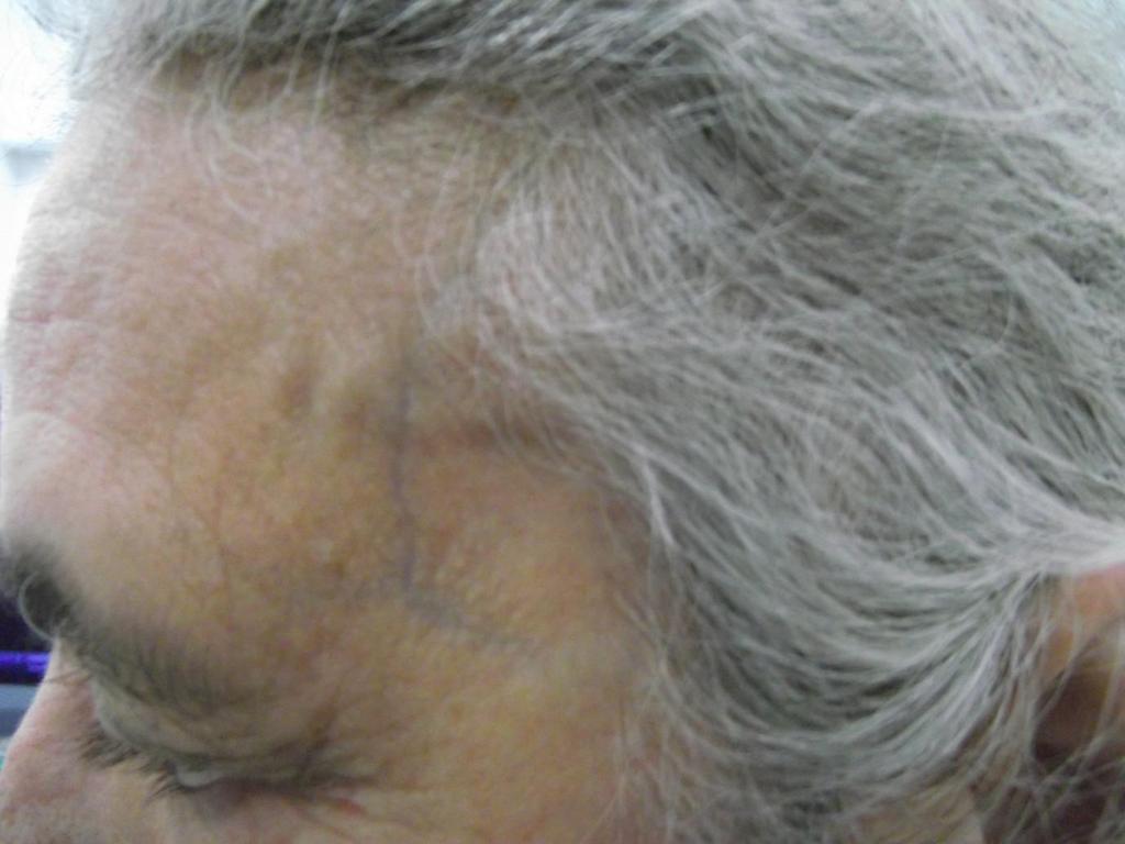 Persistan baş ağrısı 50 yaş üstü temporal baş ağrısı: temporal arterit