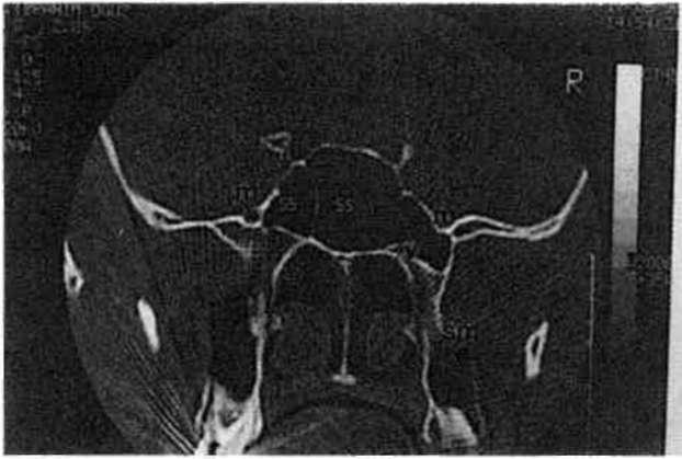 Processus pterygoideus'lardan geçen frontal CT kesitinde sfenoid sinüsün processus pterygoideus içine doğru pneumatizasyonu görülmekte; SS sinus sphenoidalis; m nervus maxillaris; v nervus Vidii; sm