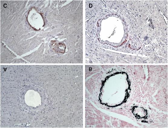 Yüksek doz PTH infüzyonu yapılan sıçanların kalsifiye koroner arterlerinden Nitrotyrosine ve FGF-23 immunohistokimyasal ekspresyonu Custódio M R et al. Nephrol. Dial. Transplant.