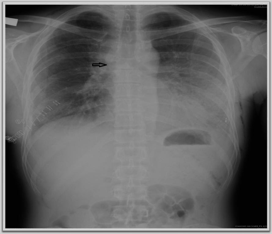 Postoperatif anastomoz hattındaki sekresyon temizliği ve anastomoz hattının değerlendirilmesi amacıyla bronkoskopi yapıldı. Klinik takiplerinde solunum sıkıntısı ve balgam retansiyonu olmadı.