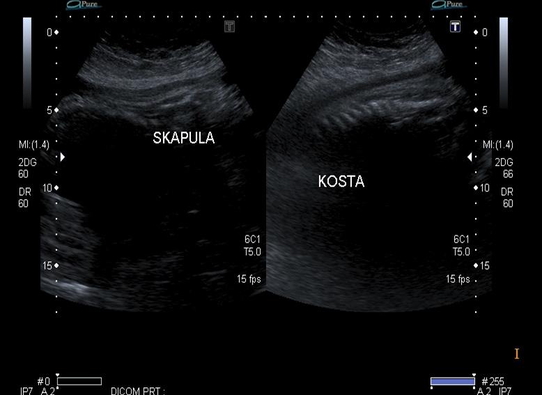 Fetal İskelet Sistemi Anomalileri 293 A B C Resim 9. A-D. (A) Osteogenezis imperfektalı bir fetüsün kraniyal hipomineralizasyon görünümü.