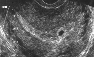 5 gebelik haftasında kese 2 mm Muhtemel