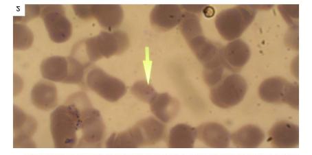 falciparum gametositi (ince yayma, Giemsa, X1250)