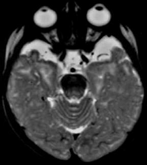 MRG Frontotemporal atrofi Yarasa kanadı görünümü Silviyan fissürlerin genişlemesi