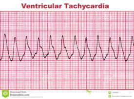Ve n t r i k ü l e r A r i t m i l e r ( Ve n t r i k ü l e r Ta ş i k a r d i ) = ( V T ) Ventrikülden kaynaklanan, en az 3 ventriküler atımın arka arkaya geldiği, hızın >100/dk olduğu, geniş QRS
