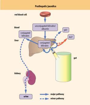 Posthepatik Sarılık Posthepatik Sarılık Unkonjuge / albümin Plasma B i konjuge ve diğer B metabolitleri, örn.