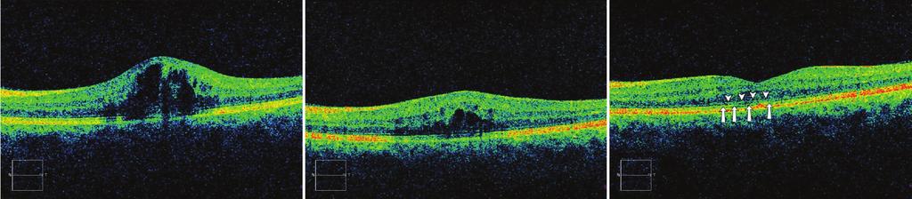106 İntravitreal Ranibizumab Tedavisi Uygulanan Retina Ven Dal Tıkanıklığına... Grafik 2a: Takip süresince EİDGK nin İVR tedavisi ile değişimi.