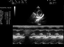 TRANSIENT CARDIAC DYSFUNCTION AFTER SUFFERING ELECTRIC SHOCK: CASE REPORT Türkay SARITAŞ et al FIGURE 4: The echocardiographic examination whic is made one week after the electric shock.