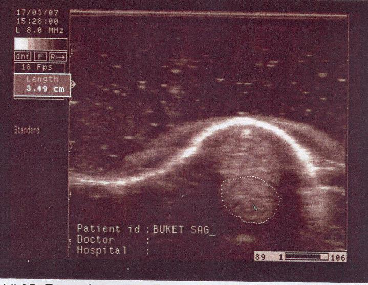 dk ikinci bölge ultrason