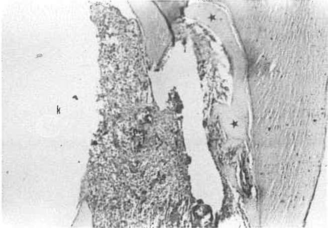 Tek başına oc-tcp kullanılan, kontamine olan gruba ait bir dişte birinci ayda pulpada şiddetli iltihabı hücre infiltrasyonu gözleniyor. H.