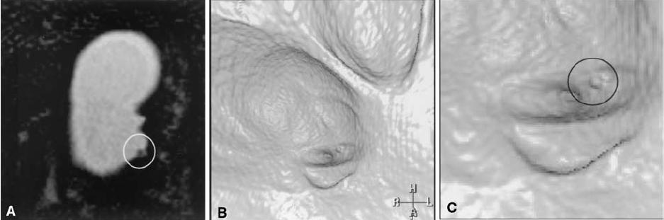 <5mm TÜMÖR Pseudodivertikül