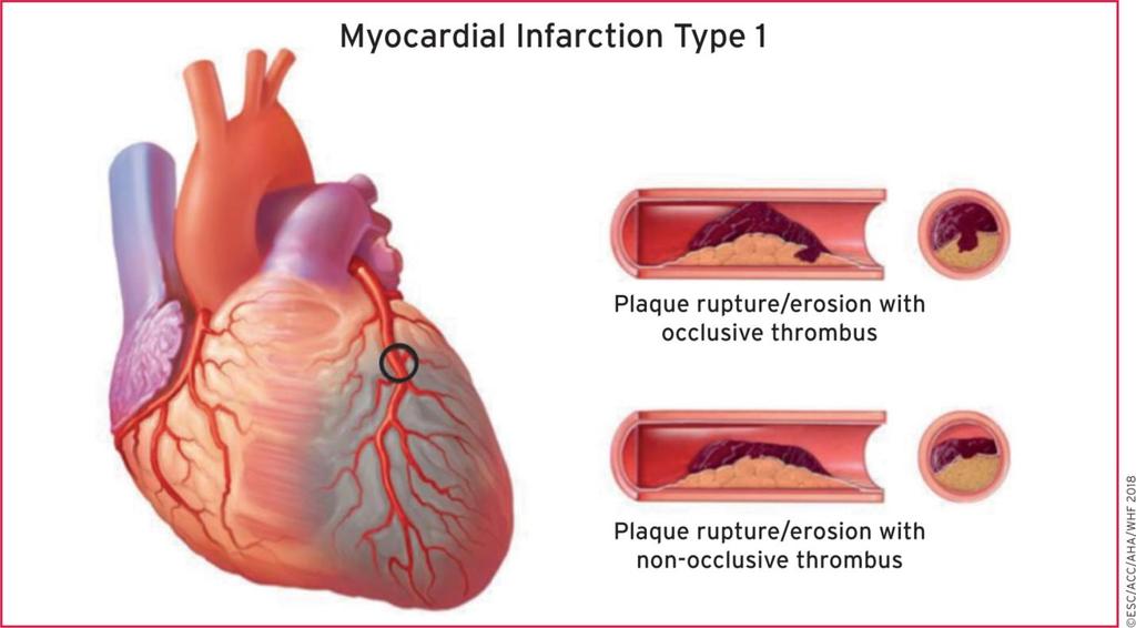 From: Fourth universal definition of myocardial infarction (2018) Eur Heart J. Published online August 25, 2018. doi:10.