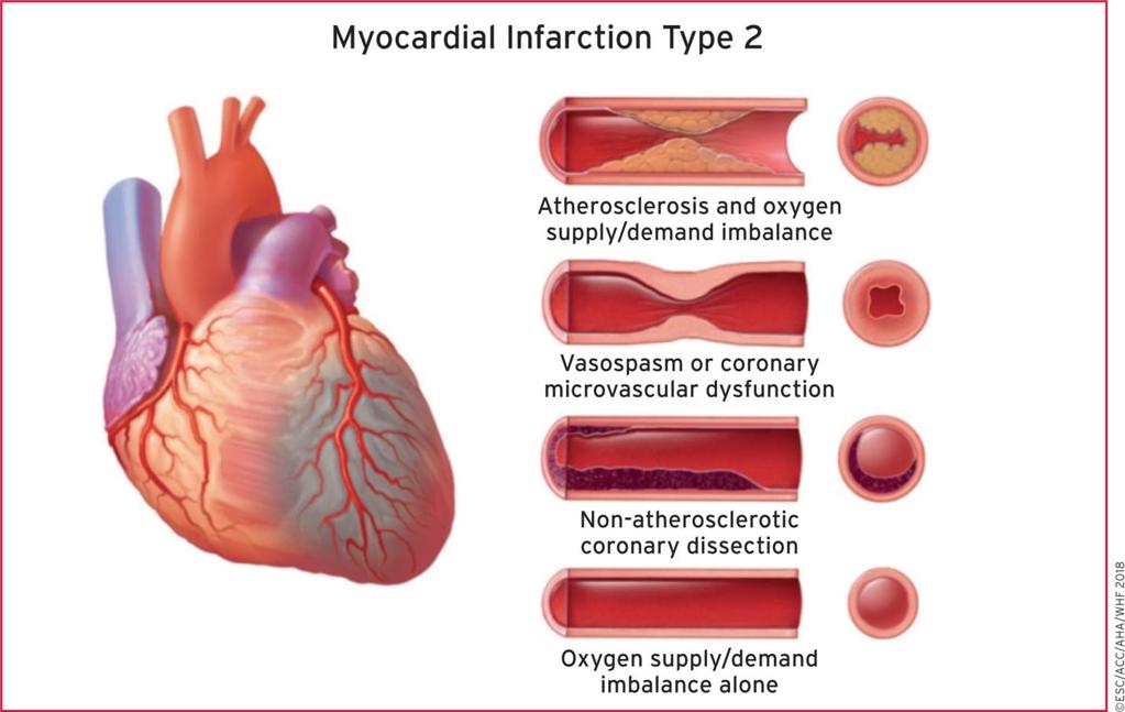 From: Fourth universal definition of myocardial infarction (2018) Eur Heart J. Published online August 25, 2018. doi:10.