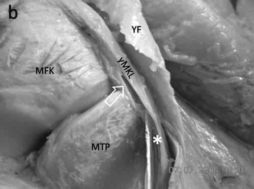 Proksimal tibiya açık fokal kubbe osteotomisinin diz eklemi mediyal laksitesi üzerine etkinliği 74 Superiorda vastus medialis kasının inferior kenarı sınır olarak kullanıldı.