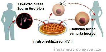 In vitro Fertilizasyon (tüp bebek) Yöntemleri -Dişi veya erkek üreme sisteminden kaynaklanan bazı sebeplerden dolayı çocuk sahibi olamama durumuna kısırlık denir.