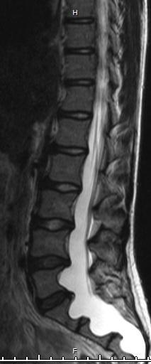 Spinal