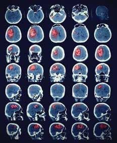 Nöropsikiyatri Bağımlılık Beyin Cerrahisi Beyindeki epileptik odağı üç boyutlu olarak gösterebilir. Psikiyatride kullanımı, araştırma amaçlıdır. 3.