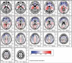 Nöropsikiyatri Bağımlılık Beyin Cerrahisi 8. Farmako EEG Nedir?: QEEG'nin beyin frekanslarının analizini yaptığını belirtmiştik.