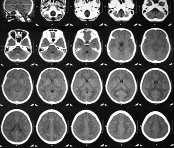 Nöropsikiyatri Bağımlılık Beyin Cerrahisi 4. MR anjiyografi ile beyin ve boyun damarlarının görüntülenmesi, darlık/tıkanıklık ve aterom plakları yönünden değerlendirme yapılması mümkündür. 5.