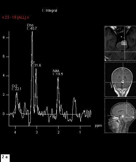 Beyin manyetik rezonans (MR) spektroskopi incelemede neoplastik süreci destekleyen N-Asetil Aspartat (NAA) düzeyinde belirgin azalma ve kolin düzeyinde belirgin