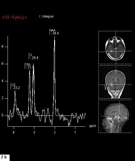 Şekil 2B : Normal nöral parenkim alanından karşılaştırma amacıyla yapılan MR spektroskopi incelemesinde NAA ve CHO düzeylerinin normal sınırlarda olduğu görülmektedir Lezyon lokalizasyonu biyopsi