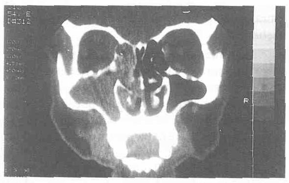 sinüzitli hastanın BT görüntüsü jik incelenmesi sonucu konmuştur. Hastalardan birisinde diabet saptanmış, diğerinde ayrıca bir patoloji bulunmamıştır.