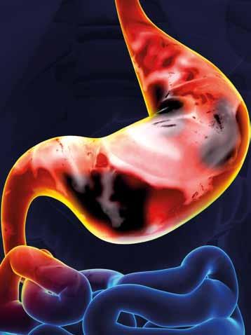Sănătate 6 CE ESTE CANCERUL DE STOMAC? Dr. Murat Gyursoy Specialist gastroenterolog Cancerul de stomac (cancerul gastric) este o tumora malignă care se dezvoltă în țesutul din stomac.