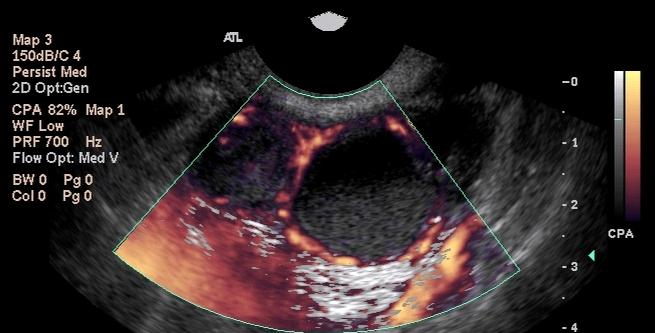 ndometriosisli Olgularda IVF de Komplikasyon zellikle ovaryan endometriomalı olgularda over apsesi