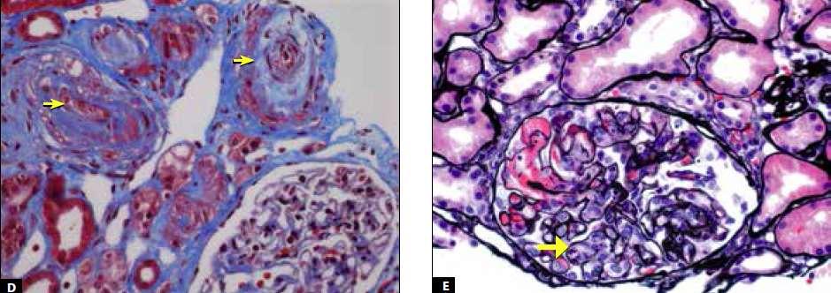 rombotik Mikroanjiyopati Patolojisi D) Classic findings of a TMA, defined histologically, on a renal biopsy of a 43-year-old man with a TMA associated with malignant hypertension.