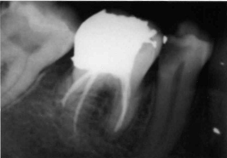 Perküsyon ve mobilite testleri normal sınırlar içindeydi. Radyografik muayenede dişteki dentin çürüğünün pulpa odası sınırlarına ulaştığı ve dişin üç köklü olduğu belirlendi (Resim 1).