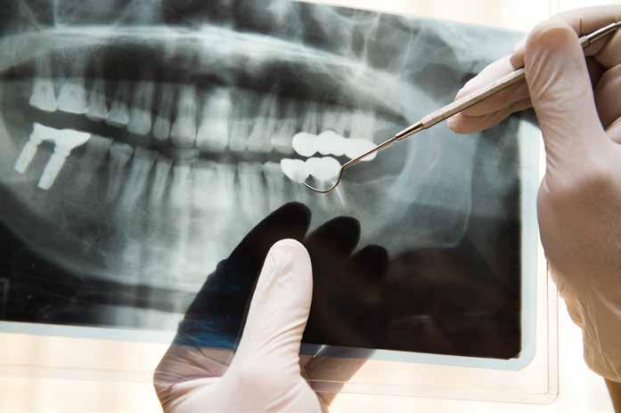 İmplant Diş kayıplarında kişilere kendi doğal dişlerin en konforlu şekilde tekrar hissettirecek uygulamadır.