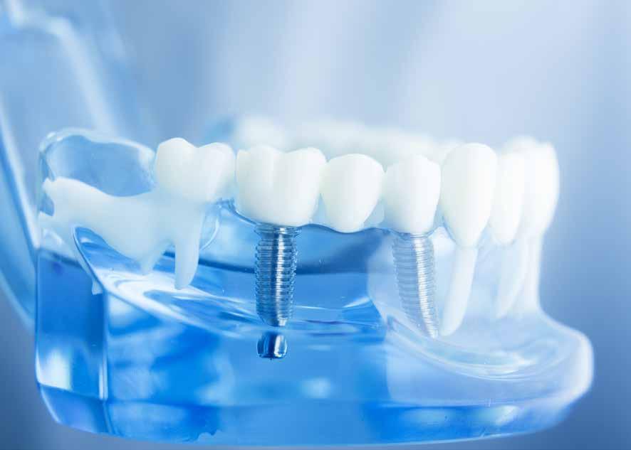 Eksilen diş boşluğunu gidermek için, boşluğun önündeki ve arkasındaki dişlerin aşındırılarak köprü protezi yapılması önlenmiş olur.