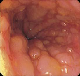 Kronik granülamatöz inflamatuar hastalık Etyoloji net değil Gastrointestinal Sistemde heryeri tutabilir 15-22 birinci zirve 55-60 ikinci zirve Kadınlarda daha sık %30 hastada