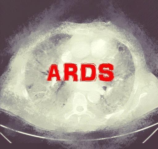 ARDS tanılı olguya yaklaşım Dr