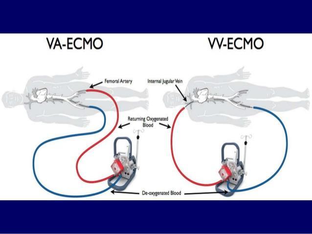 VA EKMO: Kardiak ve pulmoner destek VV EKMO:
