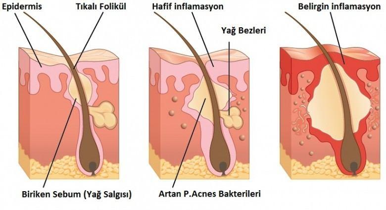 Sebum kıl folikülünün içinden geçemediği zaman akne oluşur. Folikülün astar hücreleri,sebumfolikülün içinden geçemediği için tıkanan foliküllerle birlikte dökülür ve kümelenir.