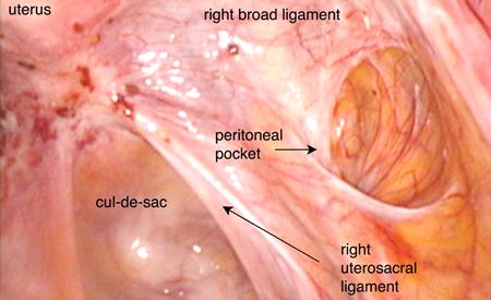 MAKALELERDEN SEÇMELER Uterosakral ligamanda endometriozis: üreteral tutulum belirteci Lima R, Abdalla-Ribeiro H, Nicola AL, Eras A, Lobao A, Ribeiro PA Fertil Steril. 2017 Jun;107(6):1348-1354.